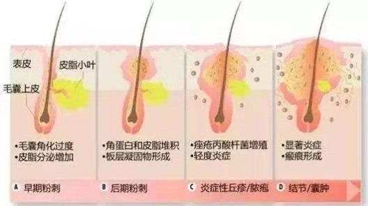 最好的解决痘痘的方法,找到问题的根源去解决痘痘