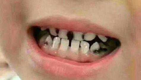 4岁宝宝天天刷牙为什么还有龋齿,4岁小孩每天刷牙为什么牙缝黑