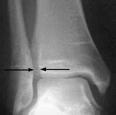篮球运动中常见的运动损伤,篮球常见运动损伤视频