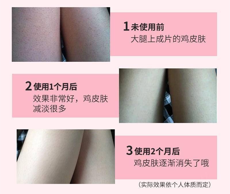 关节黑改善小妙招,关节发黑护肤小妙招