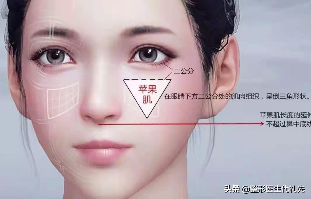 面部埋线提升能维持多久,面部埋线提升