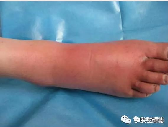 链球菌感染导致皮肤病,革兰氏阳性球菌皮肤病