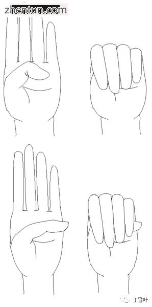 马凡综合征面容,马凡综合征最新标准