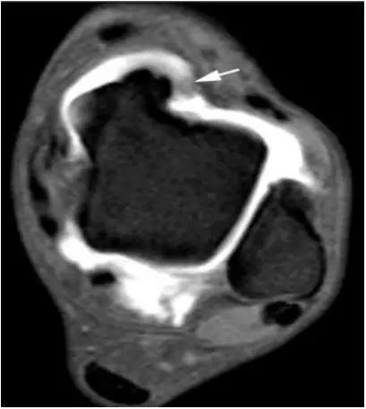 踝关节撞击症问诊,踝关节撞击综合征的x线表现
