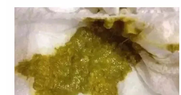 大便正常说明肠道健康吗,宝宝正常大便应该是什么样