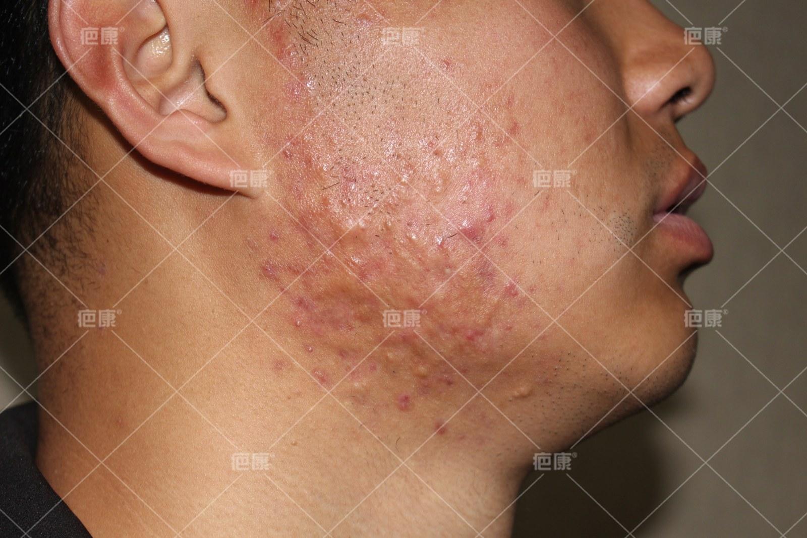 疤康治疗疼吗,疤康恢复过程视频