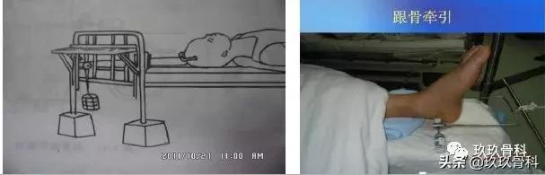 骨科术前术后注意事项,骨科手术体位安置标准流程