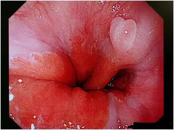 食管壁上美丽的“莲花”在无痛胃肠镜下现出了魔影