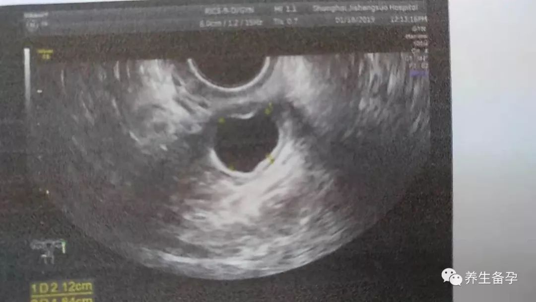 查卵泡发育做什么检查,b超监测卵泡发育不良但是怀孕了