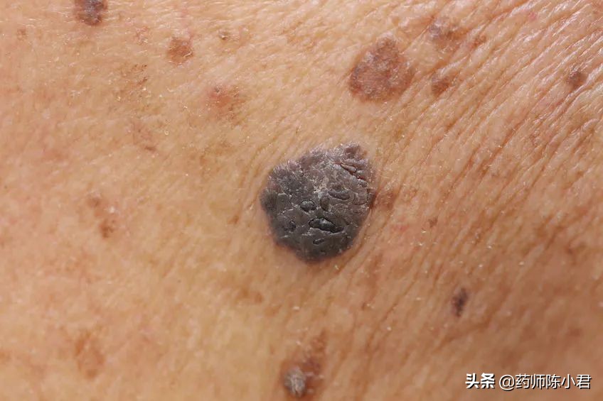 脚底黑痣癌变能治好吗,脚底黑痣割掉之后会再长出来么