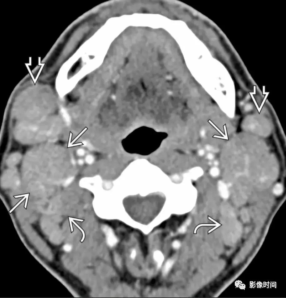 双侧颈动脉鞘间隙多发小淋巴结影,双侧颈动脉间隙多软组织密度结节