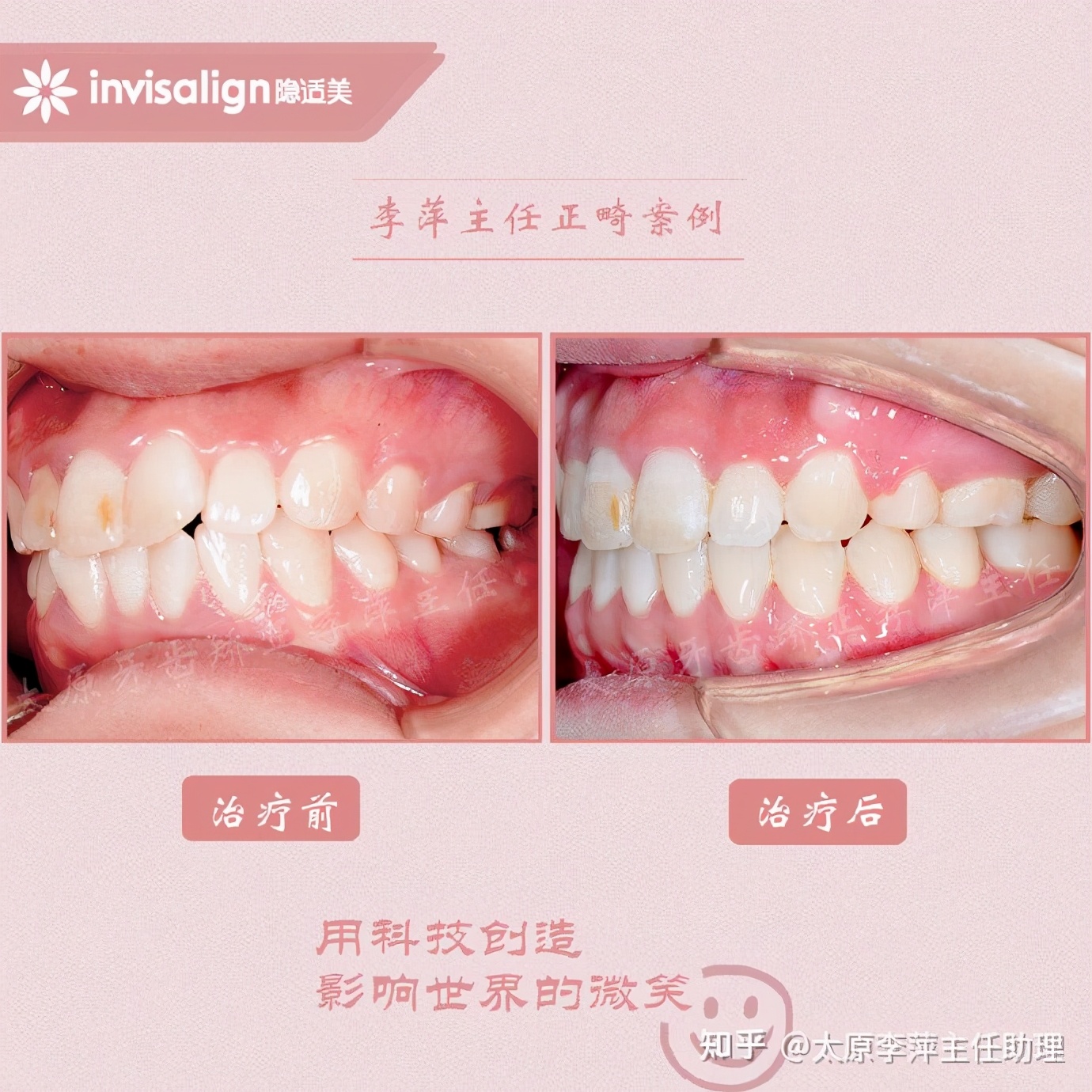 太原矫正牙齿需要做正颌吗,太原牙齿二次矫正
