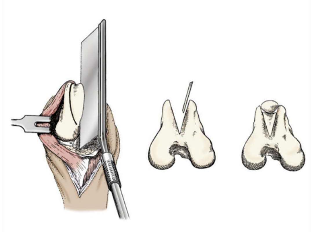 犬肩胛骨脱臼走路,犬膝盖骨骨折