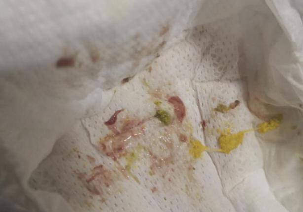 宝宝大便化验有脓细胞吃什么药,宝宝大便里有血丝粘液细菌性感染