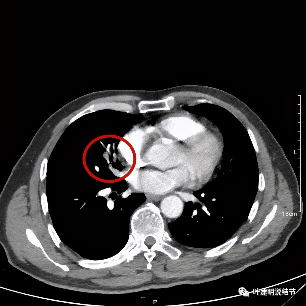 实性结节影要不要紧,实性结节穿刺活检为良性