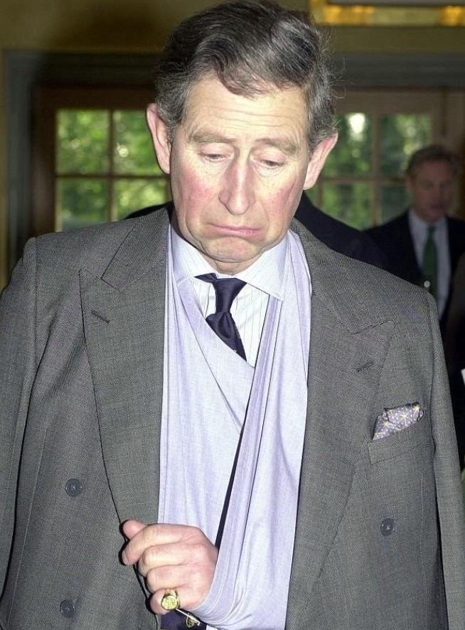 查尔斯的手指肿如香肠,查尔斯王子手指肿如香肠