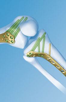 人工关节钢板,人工关节和钢板的优缺点