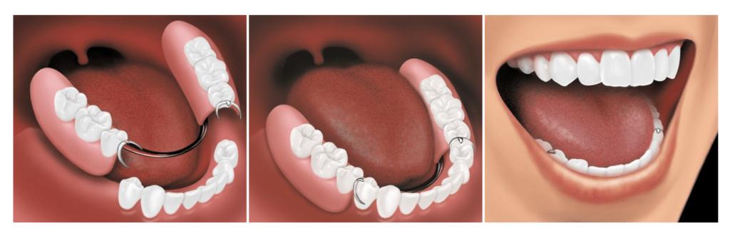 牙齿缺失多个的最佳修复方法,多颗牙齿缺失怎么修复多少钱