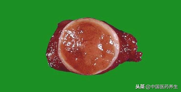 甲状腺囊肿的中药方,甲状腺肿瘤验方