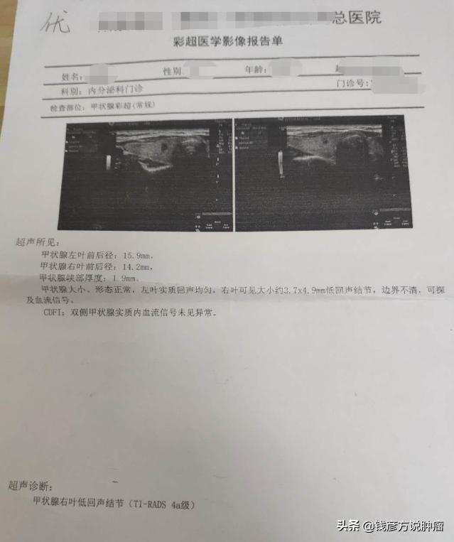 甲状腺结节3类有药吃能治好吗,甲状腺结节3类喝中药能治好么