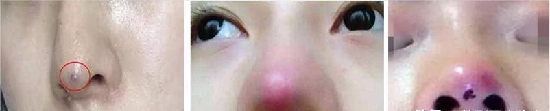 线雕隆鼻是真的吗,线雕隆鼻能维持几年还是那么挺