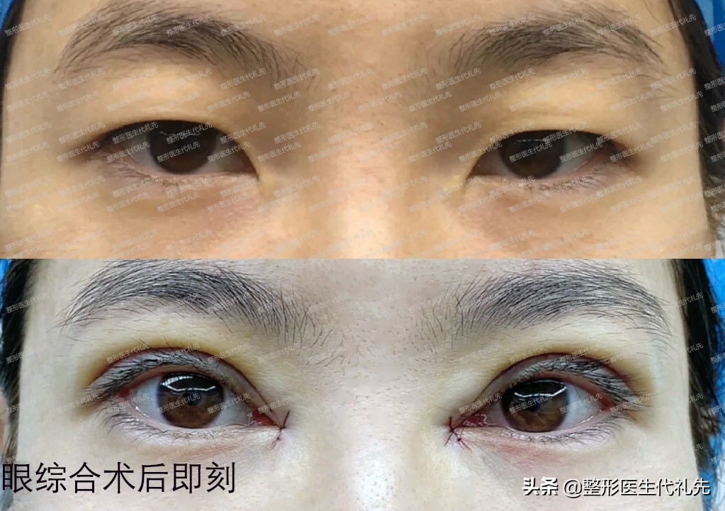 年轻眼睑松弛可以恢复吗,年纪大了眼皮松弛单眼皮变双眼皮