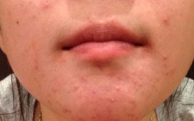 脸上长痘的几种原因,脸上长痘的三种原因