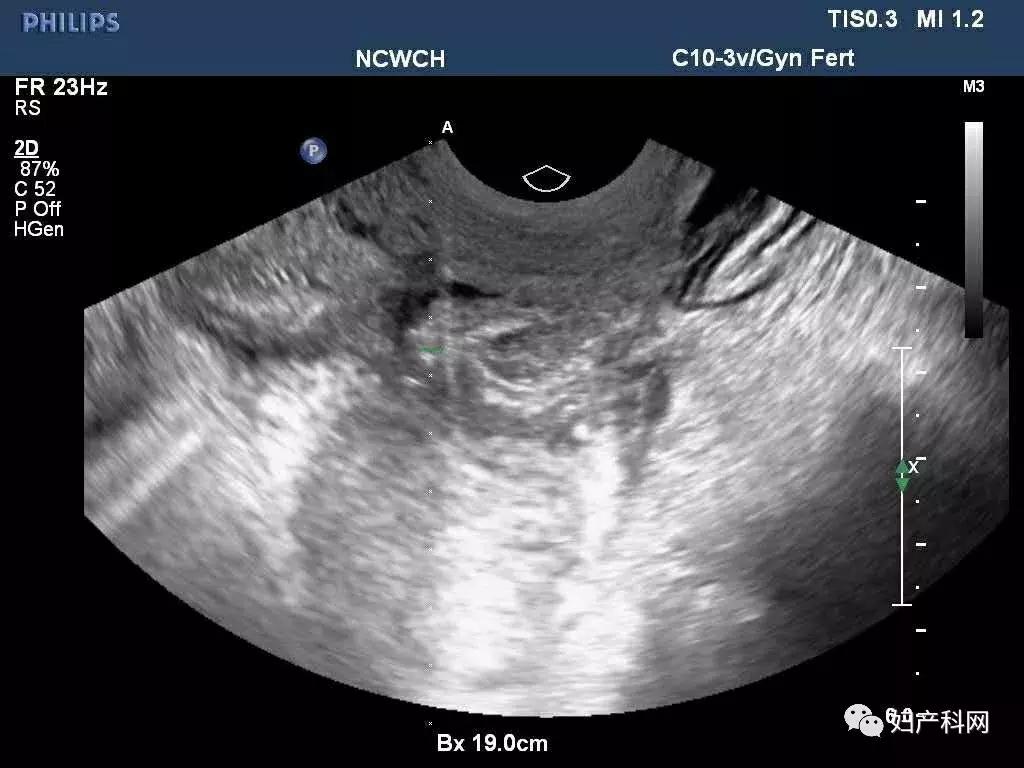 微·无创|NO.22病例分享之经阴道卵巢囊肿穿刺