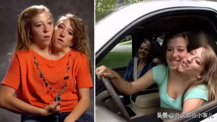 罕见双头连体人能活多久,诡异的双头生物