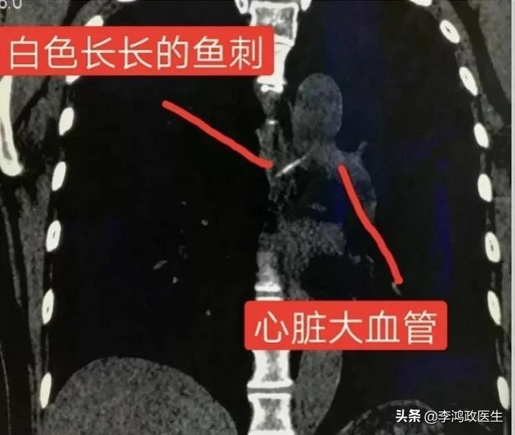 呕血死亡的人最终诊断,关于患者突然呕血死亡病例分析