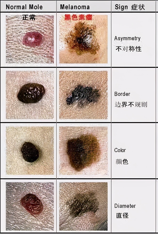 身上长了小黑点是不是癌症,头上有个黑痣是黑色素瘤吗