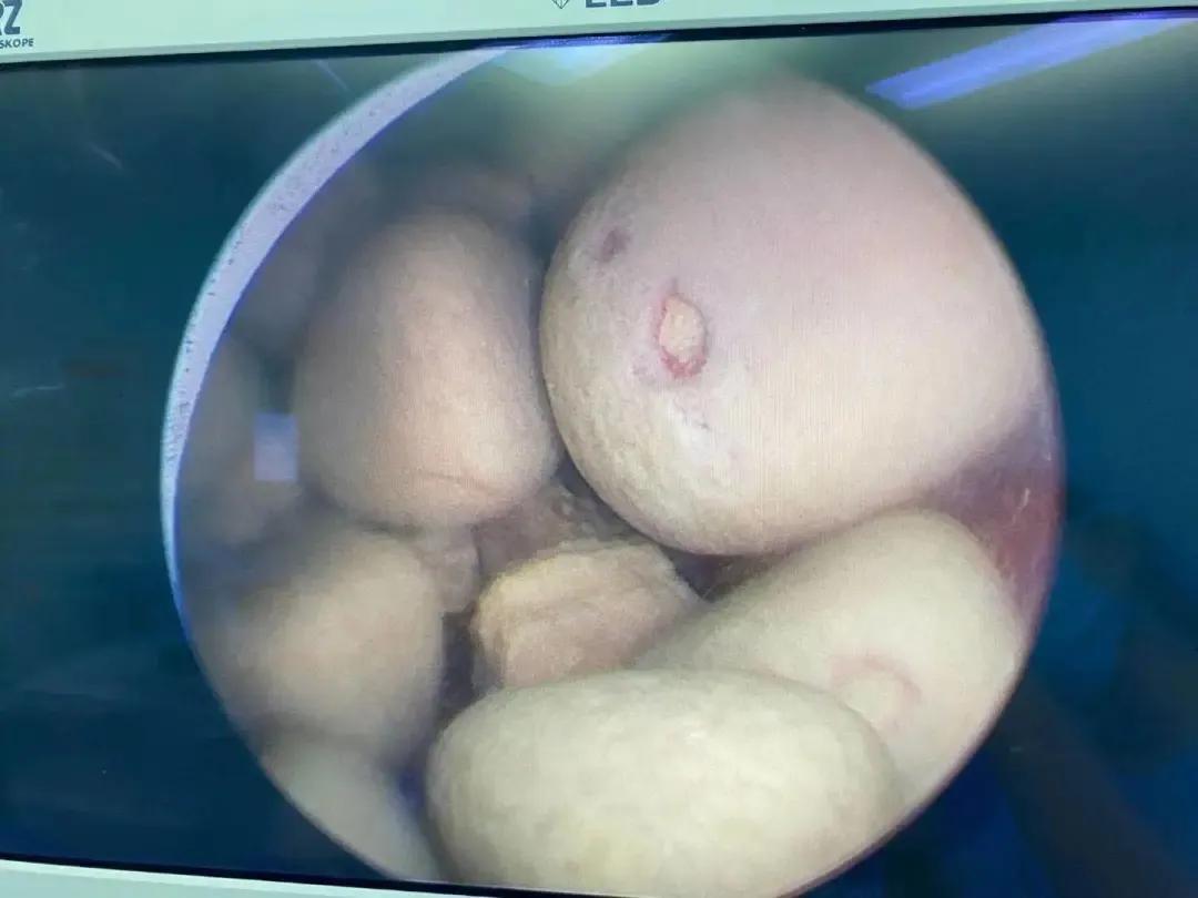 男子尿不出尿,男子突然尿无力