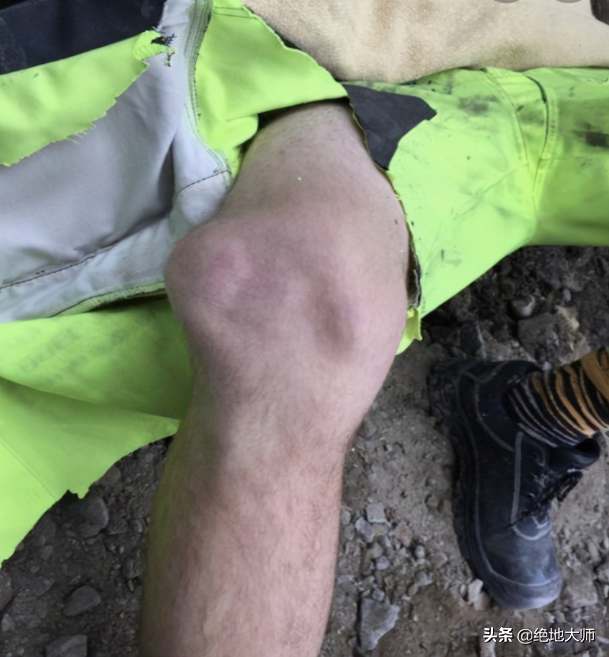 膝关节疼痛用神经阻断疗法,膝关节的疼痛与治疗综述