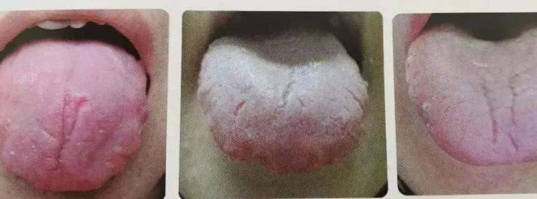 舌头上有裂纹的危害,我的舌头有裂缝