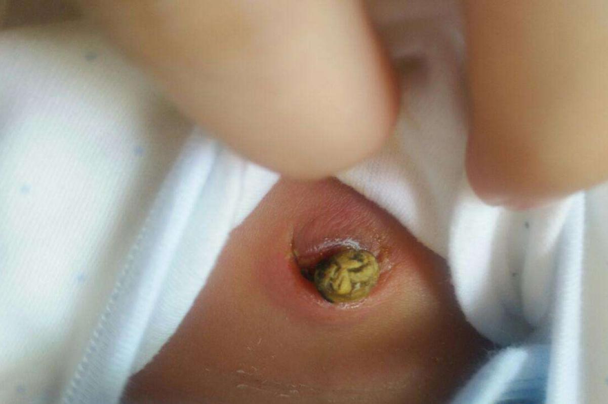 产后剪脐带会很痛吗？7天自然脱落别担心，“三不要”护理好脐带