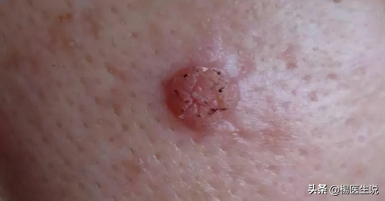 耳朵后面长了个肉瘤是怎么回事,耳朵上长了一个小肉瘤