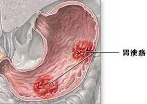 猪胃溃疡怎么治疗好得快,育肥猪胃溃疡的临床表现
