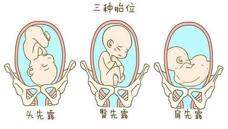 头先露胎盘1级会早产吗,胎位臀先露位什么意思