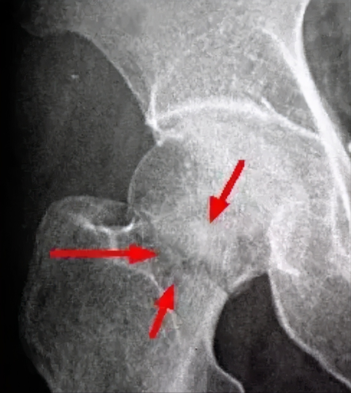 股骨头坏死的克星,股骨头坏死中成药