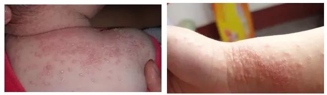 宝宝对奶粉蛋白质过敏有哪些症状,宝宝喝奶粉会过敏吗有什么症状