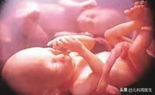 胎儿脐绕颈一周会自己绕回来吗,胎儿绕脐带3圈怎么办