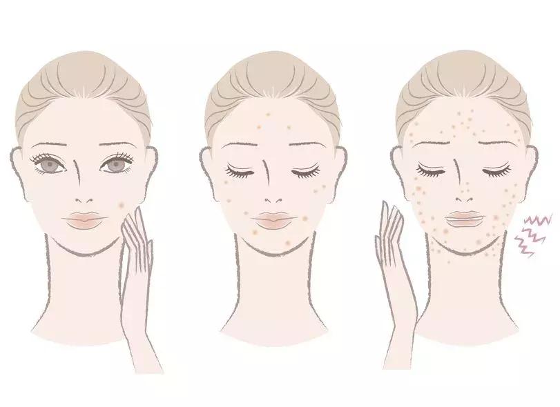 范瑞强治痘痘厉害真的还是假的,中年女性青春痘