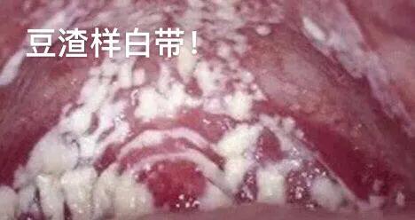 霉菌性阴道炎治愈吧,霉菌性阴道炎怎么办