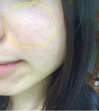 一招教你解决毛孔粗大,医生推荐毛孔粗大正确的解决方法