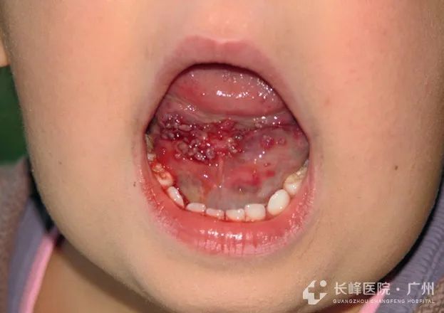 腹部淋巴管畸形介入治疗多久恢复,淋巴管畸形和静脉畸形有什么区别