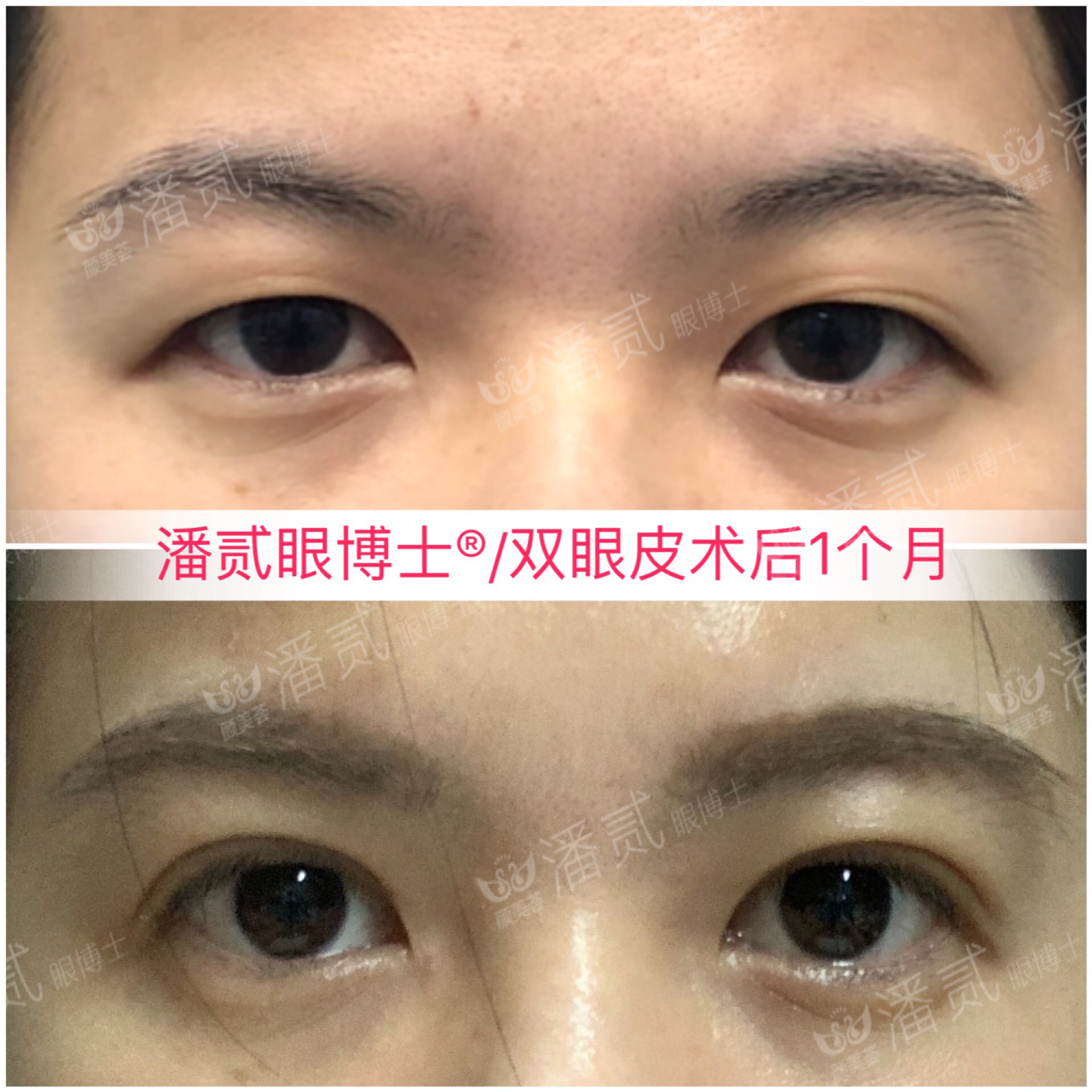 双眼皮眼尾割长了而且上扬怎么办,眼睛眼尾下垂做什么样双眼皮