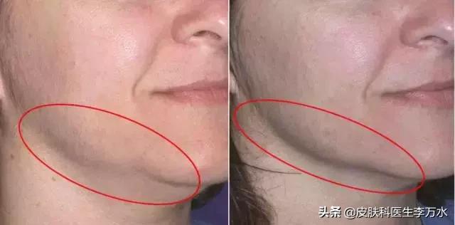 超声刀美容真的像张雨绮吗,张雨绮超声刀图片