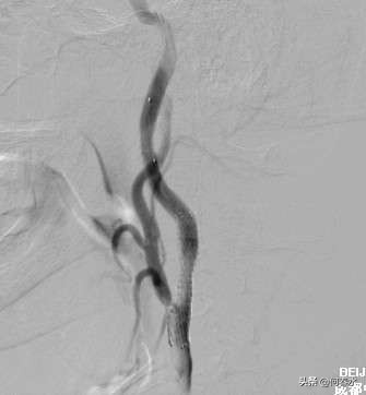 颈动脉狭窄介入治疗,颈动脉狭窄介入手术多少钱