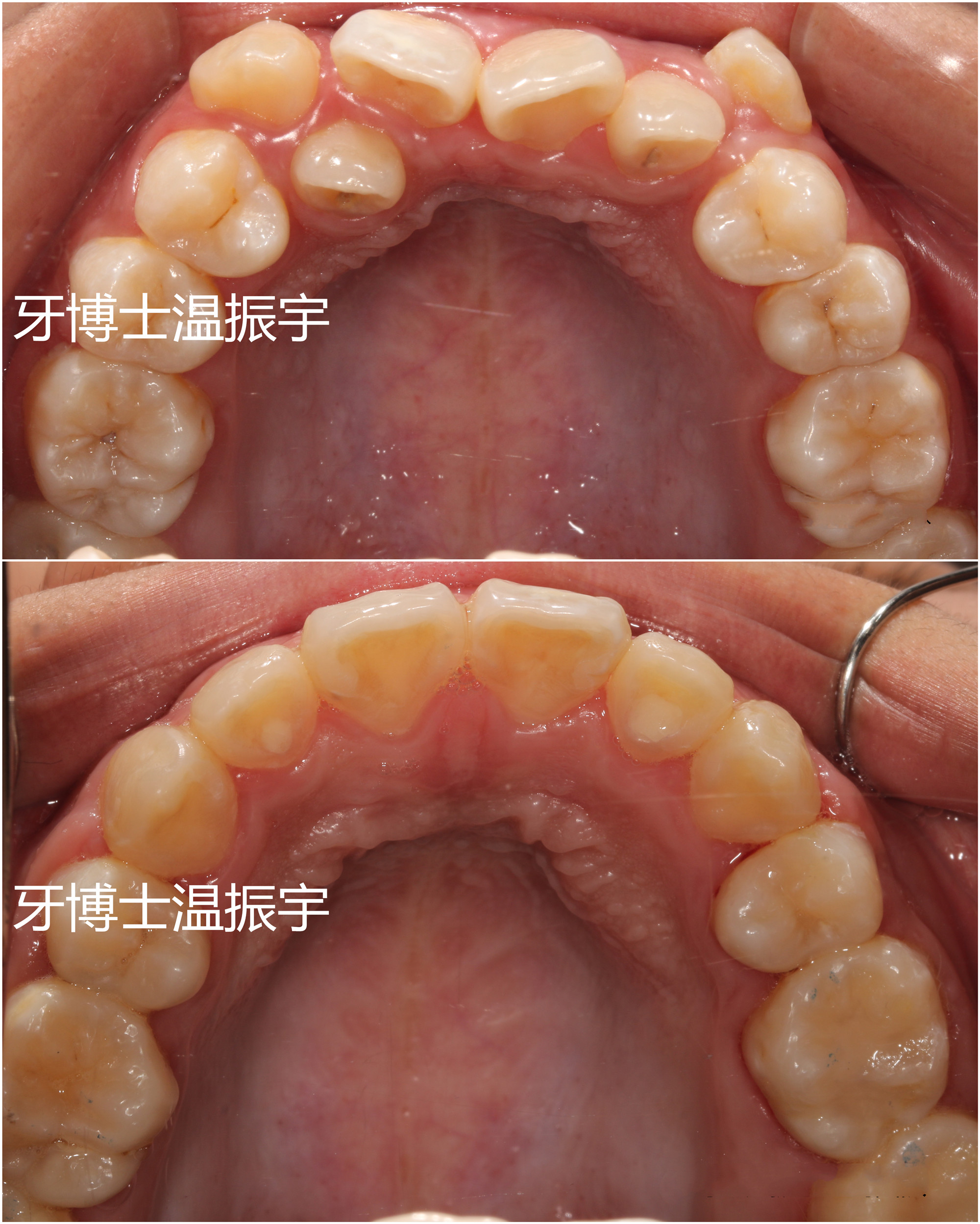 30岁了还可以做牙齿矫正吗,30岁还可以做牙齿矫正吗