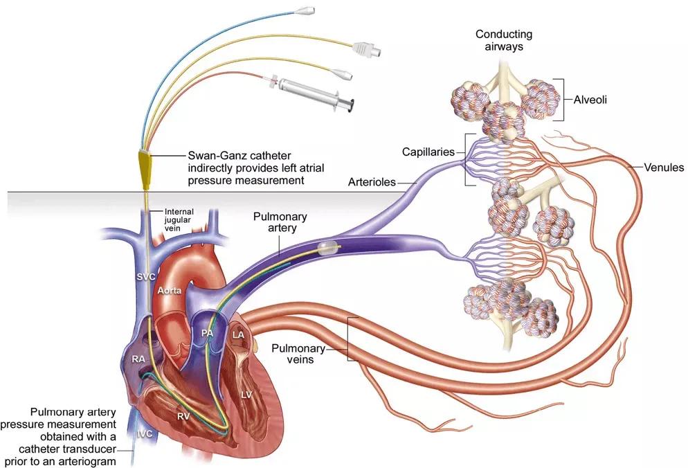 先天性心脏病主动脉与肺动脉,先天性心脏病肺动脉高压的表现